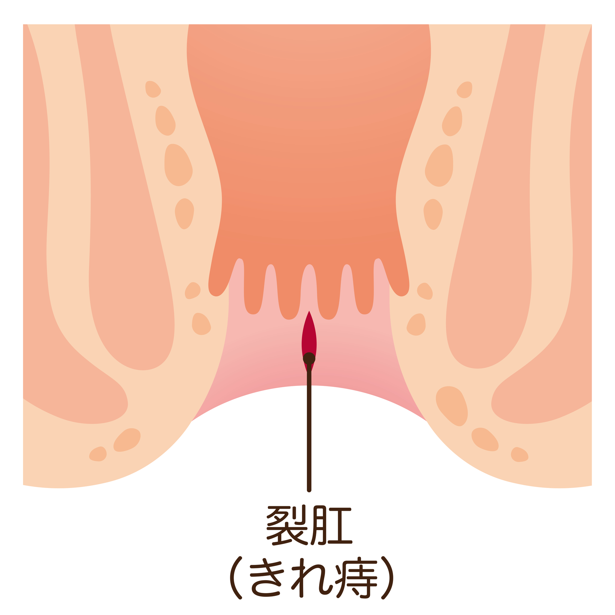 裂肛（切れ痔）