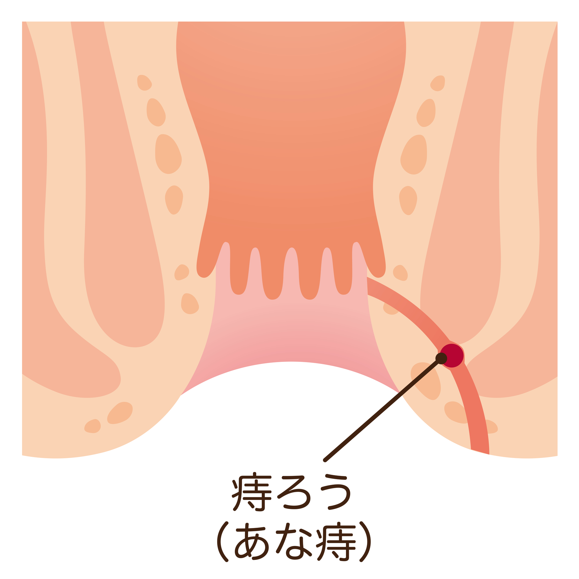 あな痔（痔ろう）